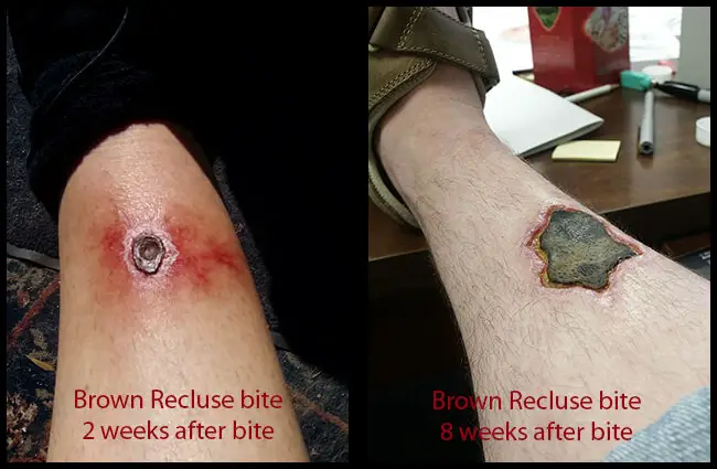 Images Of Brown Recluse Spider Bites On Humans